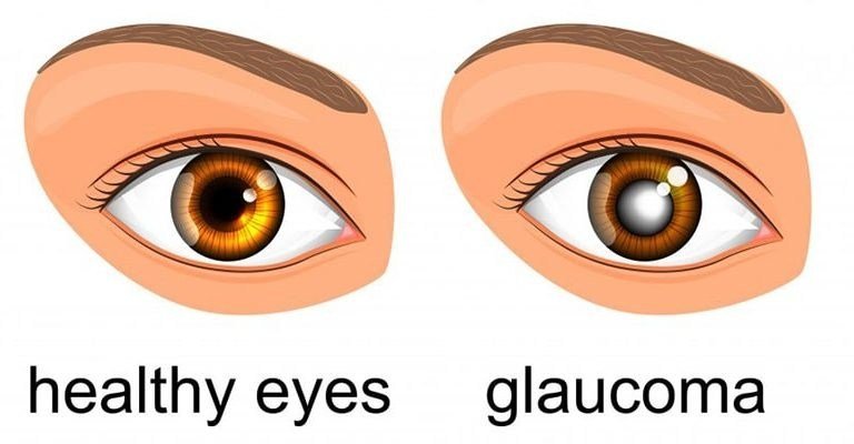 Symptoms-of-Glaucoma--768x400
